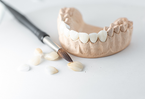 Several dental crowns covering teeth in a model of the mouth