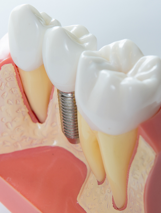 Model of a dental implant replacing a missing tooth