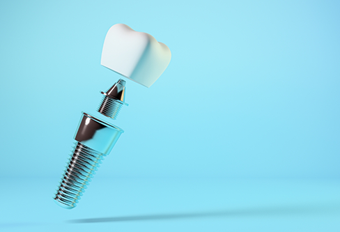 Illustration of a dental implant, a crown, and the abutment connecting them