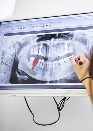 Dentist marking an x ray of teeth on a screen