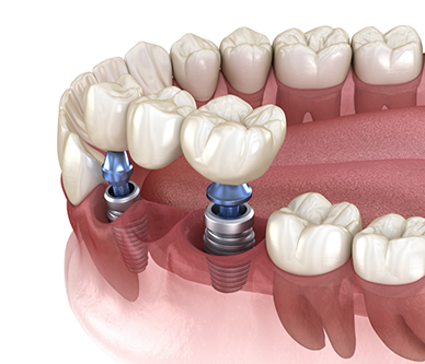 Illustration of a dental bridge being supported by two dental implants
