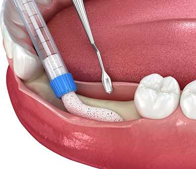 Illustration of bone grafting material being applied to the lower jaw after tooth extractions