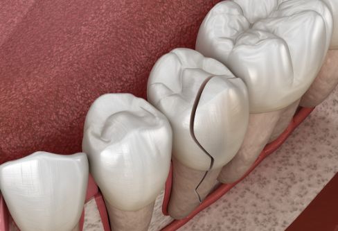 Illustration of a cracked tooth in a mouth