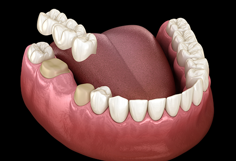 Illustration of a dental bridge fitting over two teeth to fill the gap between them