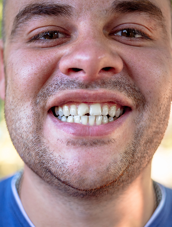 Smiling man with a chipped front tooth