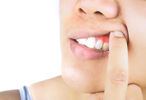 Person pointing to a red spot in their gums
