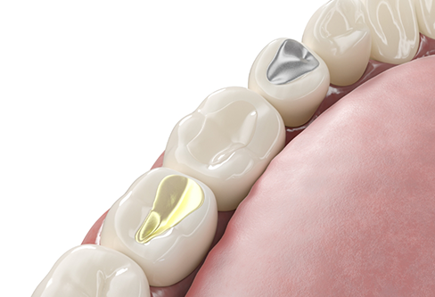 Illustrated row of teeth with sealants protecting the chewing surfaces