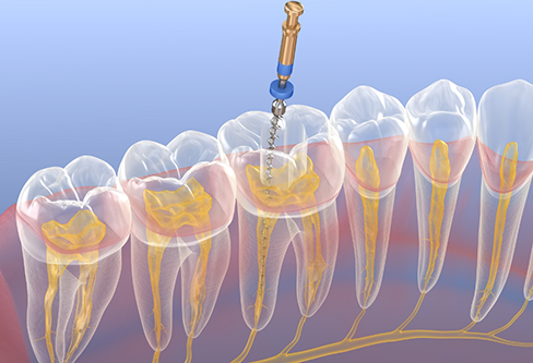 Illustration of a thiin dental instrument treating the inner layer of a tooth