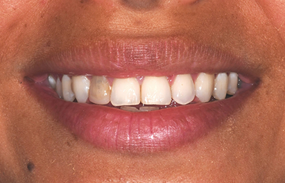 Smile with one gray stained tooth