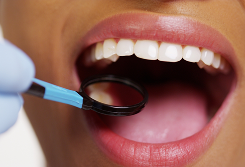 Close up of a dental mirror inside of a mouth