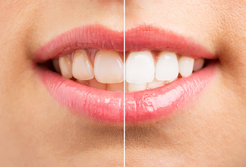Close up of a smile before and after getting teeth whitening