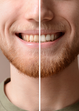 Close up of a man smiling before and after teeth whitening treatment