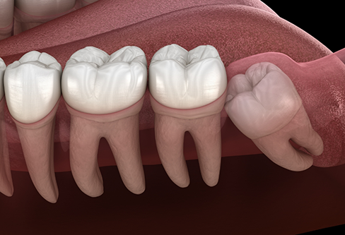 Illustration of an impacted wisdom tooth pressing against the adjacent tooth