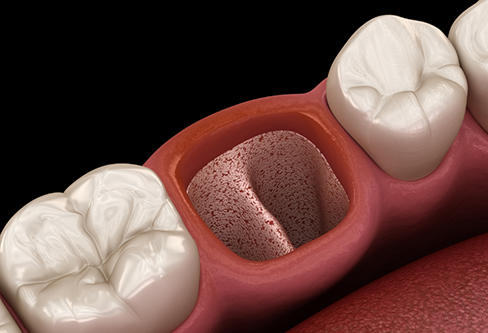 Illustration of an empty socket after a tooth extraction