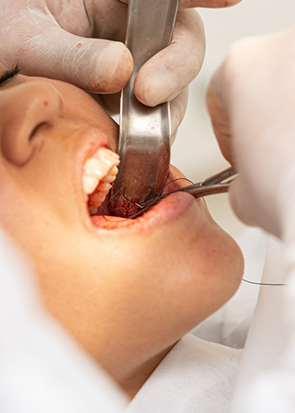 Close up of a woman undergoing a tooth extraction