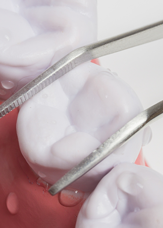 Model of tweezers removing a tooth