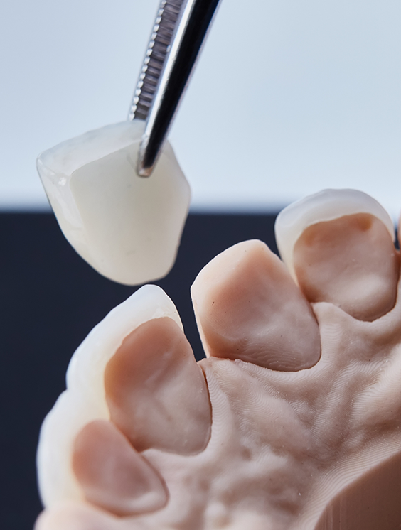 Tweezers placing a veneer over the front surface of a model of a tooth