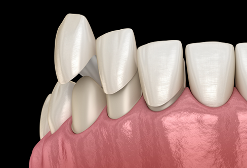 Illustration of veneers being placed over the front surfaces of teeth